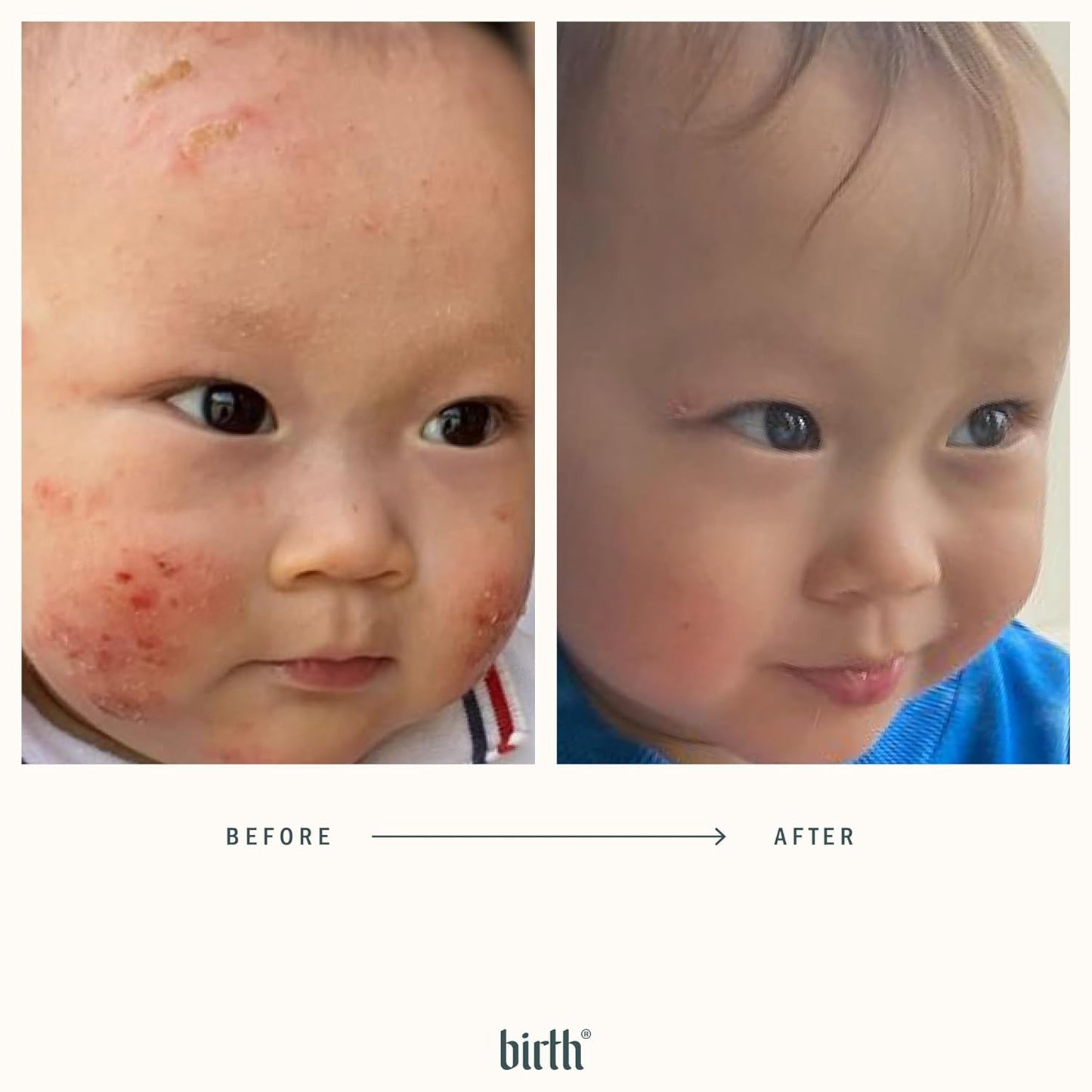 BIRTH SKINCARE Eczema Organic Baby Serum for Newborn and Infant, Redness Relief Moisturizer for Dry skin, Steroid Free 20z 59 ml Baby Ointment Body Serum for itchy Skin Relief, Made In Canada